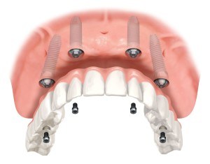 all on four dental implant denver