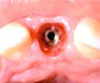 Inserción de implante para sustituir diente frontal faltante