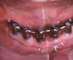 Cinco implantes inferiores retenidos con barra en la que se apoya la dentadura.