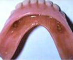 Dentadura inferior