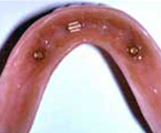 Parte interna de la dentadura con clip de retención