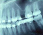 Posición del seno demasiado baja para permitir la colocación de implantes.