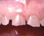 Bordes de la encía irregulares con dientes cortos y astillados