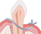 Se sutura la encía al hueso para reducir el espacio residual.