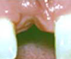 Defecto severo en el reborde alveolar después de una extracción