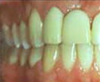 Un reborde deficiente provoca que el diente artificial se vea poco natural