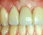 Reborde aumentado y expandido, el diente artificial parece que emerge de la encía