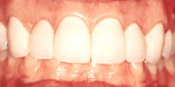 Después de remodelar la encía y de la colocación de carillas dentales (veneers), se logra una hermosa sonrisa, con dientes el tamaño adecuado en la cara del paciente.