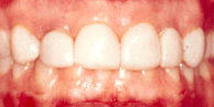 Una sonrisa gingival provoca que los dientes luzcan cortos y con bordes irregulares.