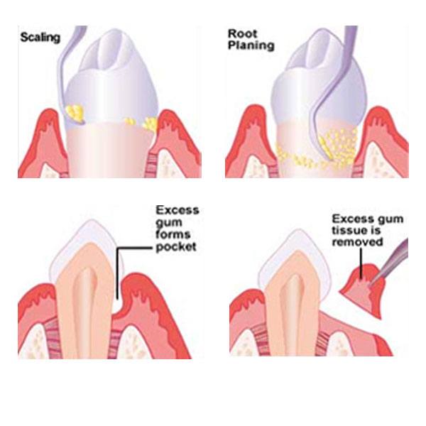 Periodontal Disease Denver