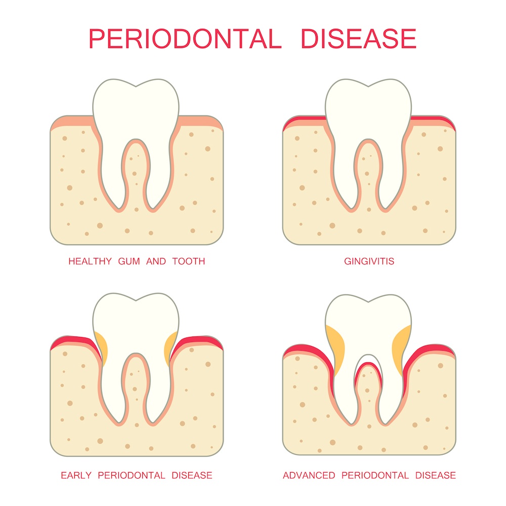 Periodontal Disease