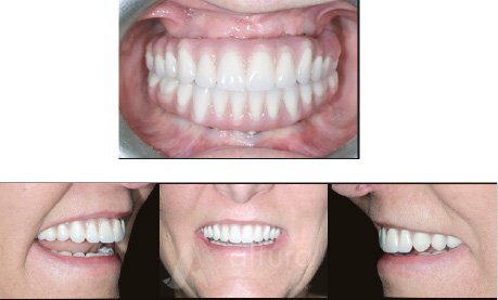 All on Four Dental Implant