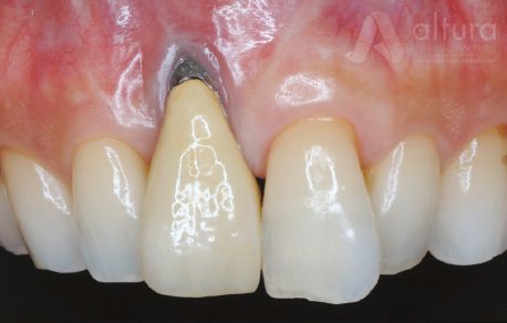 Dental Implant in Denver Colorado