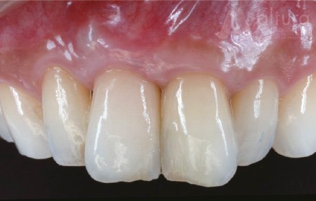 Altura Periodontal