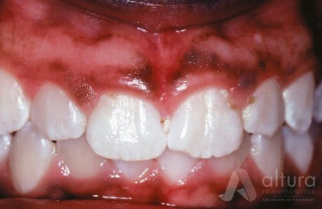Denture Dentist