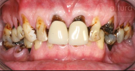 All on Four Dental Implant Case